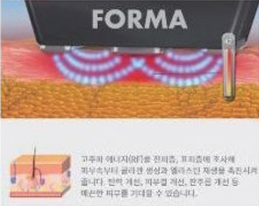 FORMA 고주파 에너지 피부 개선 원리